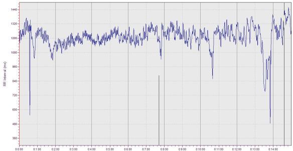 ectopic_disturbed tachogram